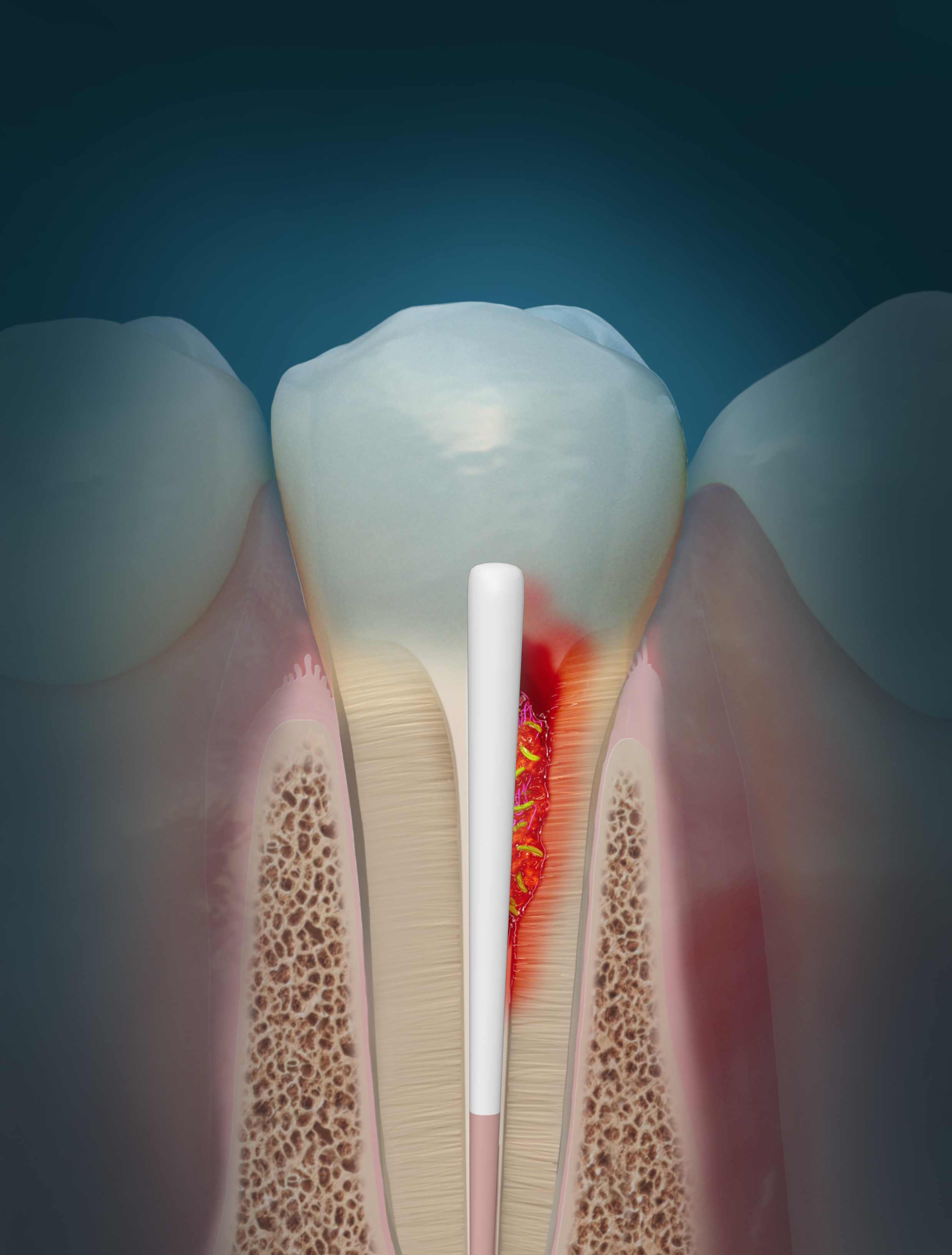 Endodontic Infection